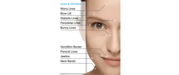 Close-up illustration of a woman's face with labels pointing to various types of lines and wrinkles including worry lines, brow lift, glabella lines, periorbital lines, bunny lines, and more. This detailed guide is essential for understanding the areas targeted by anti-wrinkle injections.