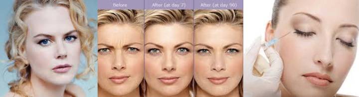 A woman's face before and after anti-wrinkle injections.