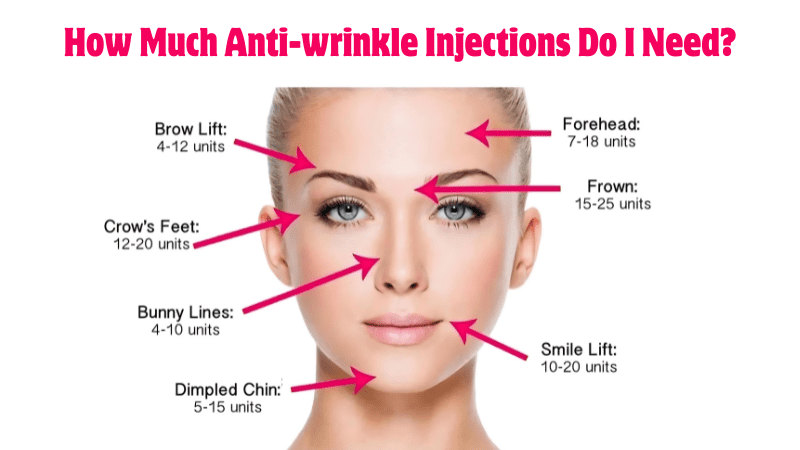 Diagram showing recommended units and dosage of anti-wrinkle injections for various facial areas including brow lift, forehead, frown, crow's feet, bunny lines, smile lift, and dimpled chin.