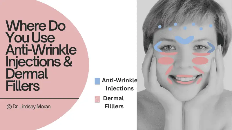 A grayscale image of a person's face with colored areas highlighting where anti-wrinkle injections (blue) and dermal fillers (red) are applied. Text: "Where Do You Use Anti-Wrinkle Injections & Dermal Fillers @ Dr. Lindsay Moran?" Discover the ultimate anti-aging treatment today!