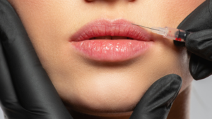 Lip lines Anti-wrinkle injections