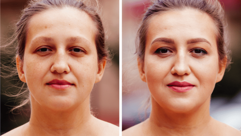 Face Slimming Injection Before and After